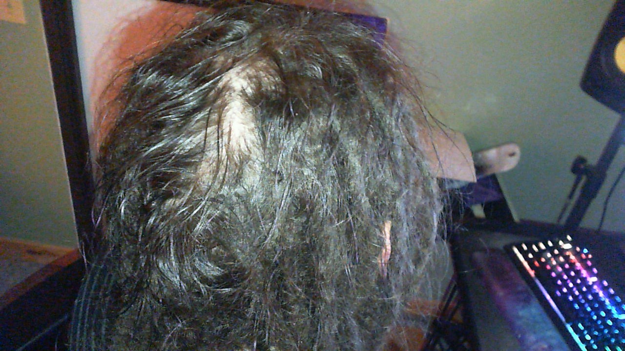 Traction Alopecia? Please Help! - Dreadlocks Forums | Dreadlocks