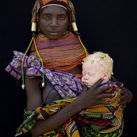 Albino baby