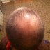 Balding cause by DreadHeadHQ methods
