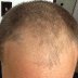 Growing with baldness