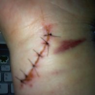 6 stitches from glass door